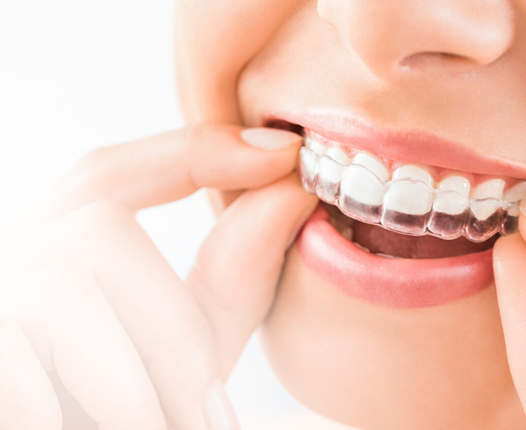 Invisalign Clear Aligners