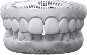 Gaps between teeth treatment