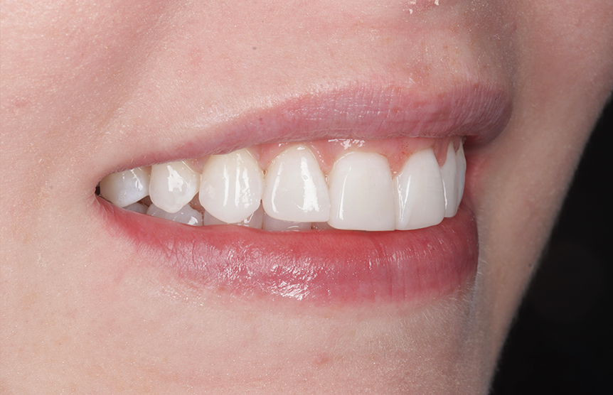 After - Meliora Dental