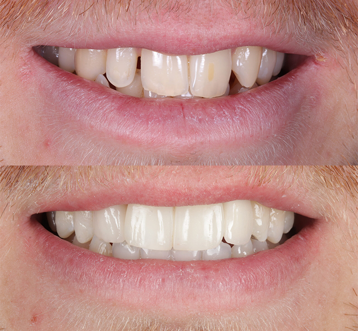 Meliora Dental - Invisalign Before and After