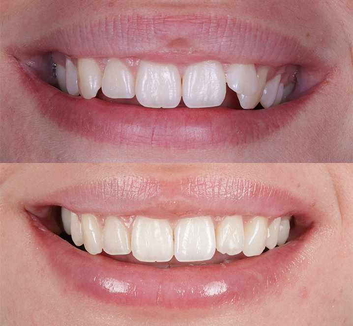 Meliora Dental - Invisalign Braces Before and After