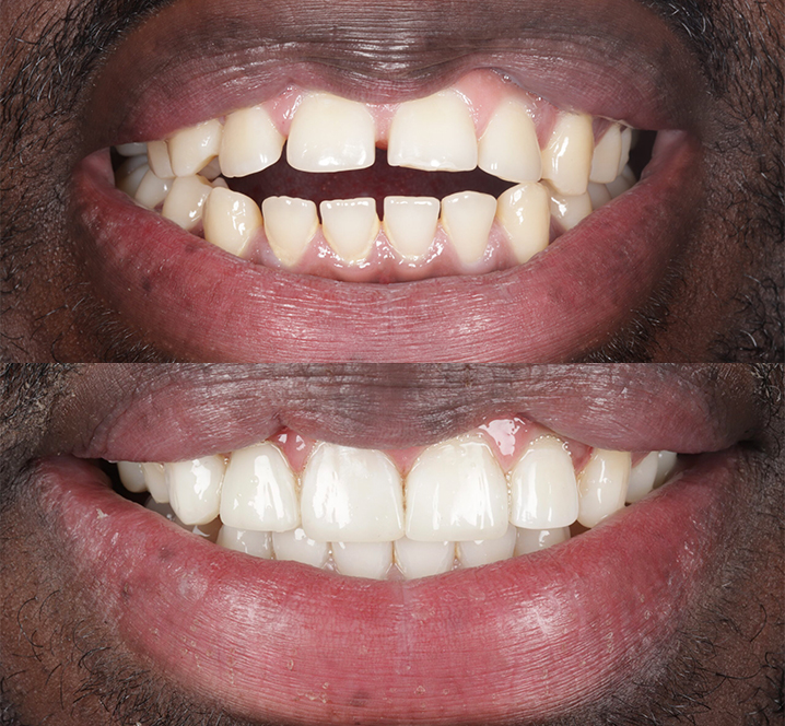Meliora Dental - Invisible Braces Before and After