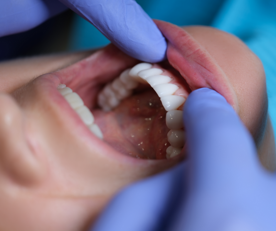 Female patient at the dentist. Close up of her teeth an the dentist's gloved hands. 