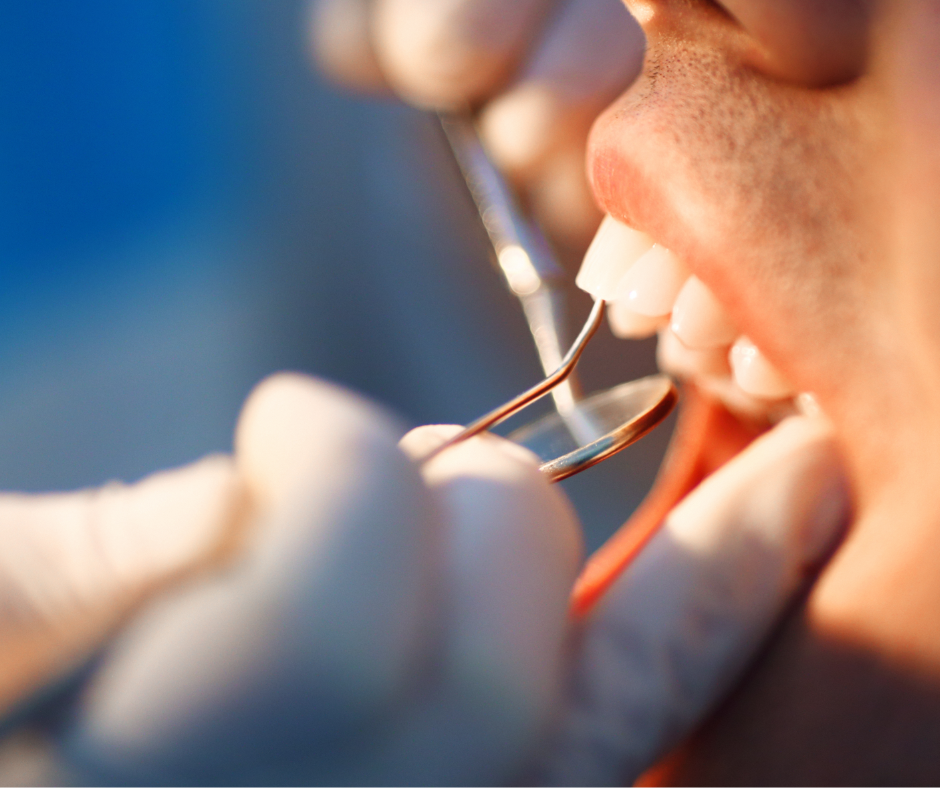 Close up of the side profile of a male patient's mouth at the dentist.