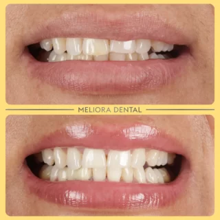 Check out this incredible transformation with Enlighten Whitening at Meliora Dental! 🌟😁 Our advanced whitening treatment has given our patient a brighter, more radiant smile that truly stands out. ✨🦷

Enlighten Whitening offers a powerful yet gentle way to achieve a whiter smile, enhancing your natural brilliance and boosting your confidence. The result? A dazzling, white smile you’ll love to show off! 🌼

Ready to brighten your smile? Book your consultation at Meliora Dental today and discover the difference Enlighten Whitening can make! 📅👍

🦷✨ #melioradental #enlightenwhitening #smiletransformation #brightsmile #confidenceboost #oralhealth #beautifulsmile #dentistry