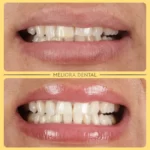 Check out this incredible transformation with Enlighten Whitening at Meliora Dental! 🌟😁 Our advanced whitening treatment has given our patient a brighter, more radiant smile that truly stands out. ✨🦷

Enlighten Whitening offers a powerful yet gentle way to achieve a whiter smile, enhancing your natural brilliance and boosting your confidence. The result? A dazzling, white smile you’ll love to show off! 🌼

Ready to brighten your smile? Book your consultation at Meliora Dental today and discover the difference Enlighten Whitening can make! 📅👍

🦷✨ #melioradental #enlightenwhitening #smiletransformation #brightsmile #confidenceboost #oralhealth #beautifulsmile #dentistry