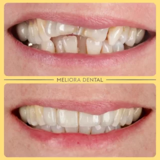 ✨ Smile Makeover Magic ✨

Transforming smiles, one veneer at a time! 🌟 This stunning makeover was achieved using e.max veneers, crafted to look completely natural and blend seamlessly with your teeth.

These veneers are more than just a cosmetic upgrade—they’re durable, strong, and designed to enhance your unique smile. Whether it’s reshaping, fixing discoloration, or creating a flawless look, e.max veneers deliver a long-lasting, beautiful finish. 💎

Thinking about a smile transformation? Let’s make it happen!

#SmileMakeover #Veneers #NaturalSmile #CosmeticDentistry #DreamSmile