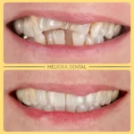 ✨ Smile Makeover Magic ✨

Transforming smiles, one veneer at a time! 🌟 This stunning makeover was achieved using e.max veneers, crafted to look completely natural and blend seamlessly with your teeth.

These veneers are more than just a cosmetic upgrade—they’re durable, strong, and designed to enhance your unique smile. Whether it’s reshaping, fixing discoloration, or creating a flawless look, e.max veneers deliver a long-lasting, beautiful finish. 💎

Thinking about a smile transformation? Let’s make it happen!

#SmileMakeover #Veneers #NaturalSmile #CosmeticDentistry #DreamSmile