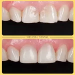 Check out this amazing composite bonding transformation at Meliora Dental! 🌟🦷 We enhanced the patient’s smile by using composite bonding to correct imperfections, giving them a flawless, natural-looking result. 😁✨

Composite bonding is a quick and effective solution for improving the shape and appearance of your teeth, providing stunning results without extensive procedures. 🌼

Want to enhance your smile? Book your consultation at Meliora Dental today and discover how composite bonding can help you achieve a beautiful, confident smile! 📅👍

🦷✨ #melioradental #compositebonding #smiletransformation #teethenhancement #newsmile #confidenceboost #oralhealth #cosmeticdentistry #beautifulsmile