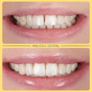 Check out this fantastic transformation at Meliora Dental! 🌟😁 We used clear aligners to gently straighten and close the gap between our patient’s two front teeth, giving them a beautifully aligned and seamless smile. ✨🦷

Clear aligners offer a comfortable, discreet solution to gaps and misalignment, helping you achieve the perfect smile without the need for traditional braces. The result? A confident, gap-free smile that looks completely natural! 🌼

Ready to close the gap in your smile? Book your clear aligners consultation at Meliora Dental today! 📅👍

🦷✨ #melioradental #clearaligners #gapclosure #smiletransformation #straightsmile #confidenceboost #beautifulsmile #oralhealth #dentistry
