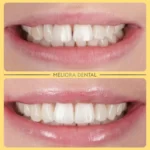 Check out this fantastic transformation at Meliora Dental! 🌟😁 We used clear aligners to gently straighten and close the gap between our patient’s two front teeth, giving them a beautifully aligned and seamless smile. ✨🦷

Clear aligners offer a comfortable, discreet solution to gaps and misalignment, helping you achieve the perfect smile without the need for traditional braces. The result? A confident, gap-free smile that looks completely natural! 🌼

Ready to close the gap in your smile? Book your clear aligners consultation at Meliora Dental today! 📅👍

🦷✨ #melioradental #clearaligners #gapclosure #smiletransformation #straightsmile #confidenceboost #beautifulsmile #oralhealth #dentistry