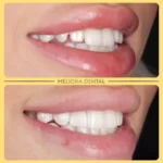Check out this stunning transformation at Meliora Dental! 🌟😁 We used composite bonding to refine and balance our patient’s smile, creating a beautifully natural look. ✨🦷

Composite bonding is a quick, effective way to enhance the shape, close gaps, or perfect the alignment of your teeth. The result? A confident, refreshed smile you’ll love! 🌼

Interested in composite bonding? Book your consultation at Meliora Dental today! 📅👍

🦷✨ #melioradental #compositebonding #smilemakeover #beautifulsmile #confidenceboost #oralhealth #dentistry