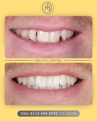 A picture is worth a thousand words, and this transformation speaks for itself!

At Meliora Dental, we’re dedicated to creating smiles that look and feel amazing. Whether it’s a subtle change or a complete transformation, your dream smile is our goal.

Ready to start your journey? Let’s make it happen.

#MelioraDental #SmileTransformation #HealthySmile #CosmeticDentistry #BeforeAndAfter #ConfidenceBoost #DentistUK #SmileGoals #DentalCare