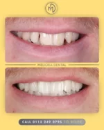 A picture is worth a thousand words, and this transformation speaks for itself!

At Meliora Dental, we’re dedicated to creating smiles that look and feel amazing. Whether it’s a subtle change or a complete transformation, your dream smile is our goal.

Ready to start your journey? Let’s make it happen.

#MelioraDental #SmileTransformation #HealthySmile #CosmeticDentistry #BeforeAndAfter #ConfidenceBoost #DentistUK #SmileGoals #DentalCare
