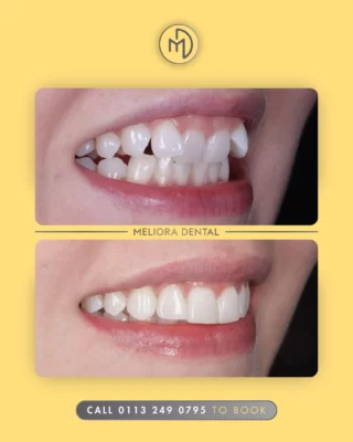 ✨ Achieve a Straighter Smile with Meliora Dental ✨

Ready for a smile transformation? Our expert teeth straightening treatments help create beautifully aligned, natural-looking results. Whether you’re fixing crowding, gaps, or bite issues, we’ve got you covered!

Book a consultation today and take the first step toward your perfect smile.

#MelioraDental #TeethStraightening #ClearAligners #Braces #SmileTransformation #ConfidentSmile #StraighterTeeth #Orthodontics #CosmeticDentistry