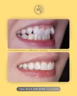✨ Achieve a Straighter Smile with Meliora Dental ✨

Ready for a smile transformation? Our expert teeth straightening treatments help create beautifully aligned, natural-looking results. Whether you’re fixing crowding, gaps, or bite issues, we’ve got you covered!

Book a consultation today and take the first step toward your perfect smile.

#MelioraDental #TeethStraightening #ClearAligners #Braces #SmileTransformation #ConfidentSmile #StraighterTeeth #Orthodontics #CosmeticDentistry