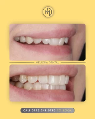 ✨ Discreetly Straighten Your Smile with Clear Aligners! ✨

At Meliora, we’re transforming smiles with comfortable, nearly invisible aligners—perfect for straightening teeth without the hassle of metal braces.

Ready for a confident, aligned smile? Book your consultation today!

#MelioraDental #ClearAligners #StraighterTeeth #SmileTransformation #ConfidentSmile #TeethAlignment #InvisibleBraces