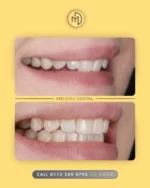 ✨ Discreetly Straighten Your Smile with Clear Aligners! ✨

At Meliora, we’re transforming smiles with comfortable, nearly invisible aligners—perfect for straightening teeth without the hassle of metal braces.

Ready for a confident, aligned smile? Book your consultation today!

#MelioraDental #ClearAligners #StraighterTeeth #SmileTransformation #ConfidentSmile #TeethAlignment #InvisibleBraces