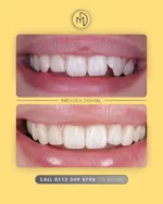 Achieve a Straighter Smile with Clear Aligners at Meliora! ✨

Say goodbye to metal braces and hello to a discreet, comfortable way to straighten your teeth. Our clear aligner treatment is designed to fit your lifestyle while delivering amazing results!

Why Choose Meliora for Clear Aligners?

🦷 Virtually Invisible – Straighten your teeth without anyone noticing.

👌 Comfortable & Removable – Eat, drink, and brush with ease.

📏 Precision-Crafted for You – A tailored approach for the best results.

⏳ Faster Than Traditional Braces – Achieve your dream smile in less time.

💳 Flexible Payment Plans – Making treatment more affordable.

Start your journey to a confident, straighter smile today! Book your consultation now.

#MelioraDental #ClearAligners #StraighterSmile #ConfidentSmile #TeethStraightening #DiscreetBraces
