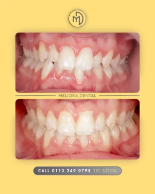 Clear aligners are a fantastic option for straightening your teeth discreetly and comfortably 😁 They gradually move your teeth into the perfect position, with no wires or brackets! ✨

Once your teeth are straightened, the next step is a teeth whitening treatment to brighten and enhance your smile even further 🌟

✔ Discreet and comfortable 🦷
✔ Perfect for a seamless smile 😁
✔ Next step: Teeth whitening ✨

Book your consultation today and take the first step towards a confident, radiant smile! 📅

#ClearAligners #SmileTransformation #StraightTeeth #TeethWhitening #MelioraDental #CosmeticDentistry