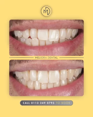 Transform your smile with clear aligners at Meliora Dental! 😁✨ Our virtually invisible aligners gently shift your teeth into place, giving you a straighter, more confident smile.

✅ Discreet & comfortable 🦷
✅ Custom-fit for precision 🎯
✅ Removable for easy cleaning 🪥
✅ Boosts confidence at every stage 😃

Next step: teeth whitening for the perfect finish! ✨

#MelioraDental #ClearAligners #SmileTransformation #StraightTeeth #ConfidenceBoost #InvisibleBraces #PerfectSmile