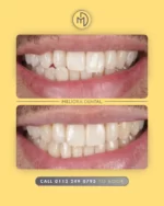 Transform your smile with clear aligners at Meliora Dental! 😁✨ Our virtually invisible aligners gently shift your teeth into place, giving you a straighter, more confident smile.

✅ Discreet & comfortable 🦷
✅ Custom-fit for precision 🎯
✅ Removable for easy cleaning 🪥
✅ Boosts confidence at every stage 😃

Next step: teeth whitening for the perfect finish! ✨

#MelioraDental #ClearAligners #SmileTransformation #StraightTeeth #ConfidenceBoost #InvisibleBraces #PerfectSmile