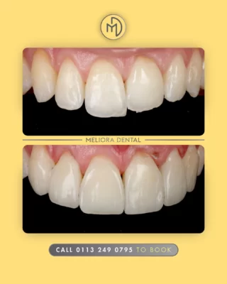 Dreaming of a smile makeover? ✨ At Meliora Dental, we specialize in creating stunning transformations that leave you smiling with confidence! 😁

Whether it’s clear aligners, veneers, teeth whitening, or composite bonding, our expert team will customize your treatment to suit your unique needs. 💎

Let’s bring out the best in your smile—one step at a time! 💖

#SmileMakeover #ConfidenceInYourSmile #DentalTransformation #MelioraDental #CosmeticDentistry #SmileGoals