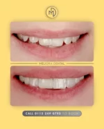 Another stunning smile makeover from Meliora Dental!

This patient came to us wanting a brighter, more even smile – and we delivered with a fully customised treatment plan. From aligning the teeth to whitening and finishing with beautiful composite bonding, the result speaks for itself.

✨ Straighter, whiter, more balanced
🦷 Composite bonding for a natural finish
📈 Confidence boosted

Let us help you love your smile again.

#MelioraDental #SmileMakeover #CompositeBonding #TeethWhitening #ClearAligners #CosmeticDentist #NaturalSmile #LondonSmiles #SmileGoals #BeforeAndAfter